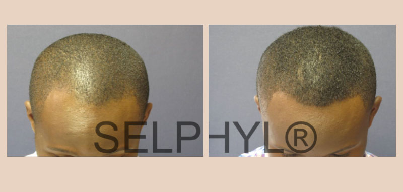 PRFM Hair Loss Before And After Gallery midtown nyc